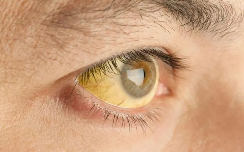 Febre amarela: sintomas, transmissão e prevenção