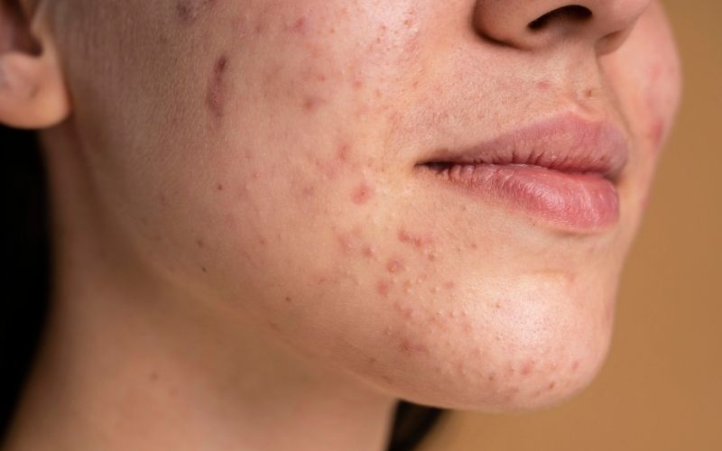 Acne: causas, tipos e quando deve procurar avaliação médica