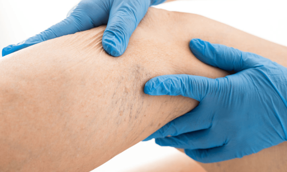 Angiologia e Cirurgia Vascular